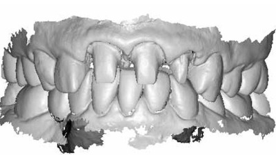 Amprenta dentara digitala