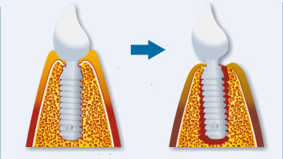 Periimplantita