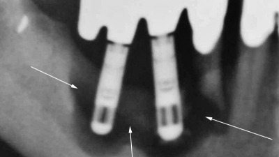 Tratament periimplantita