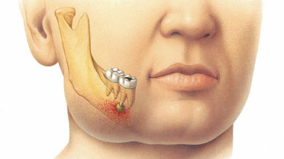 Infectia de focar dentara