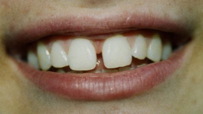 Diastema