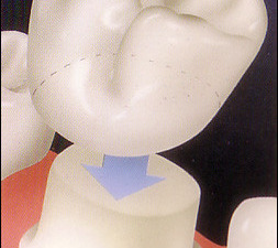 Coroana ceramică pe suport de metal vs. de zirconiu
