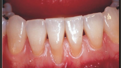 Retracţia gingivală