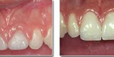 Gingivoplastia