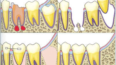 Transplantul dentar