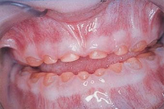 Dentinogeneza imperfecta