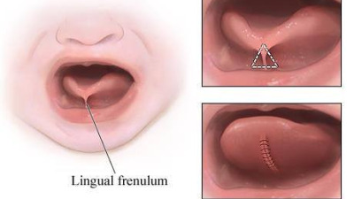 Anchiloglosia – “limba scurtă”