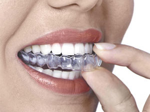 Gutiera pentru bruxism