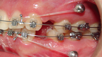 Mini-implantul dentar