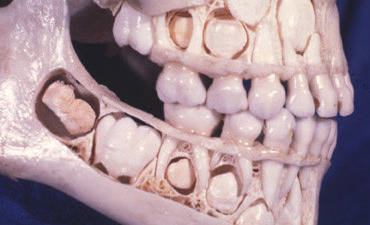 Fluoroza dentară