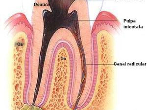 Complicatiile gangrenei pulpare