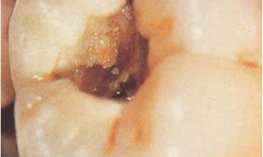 Caria dentara