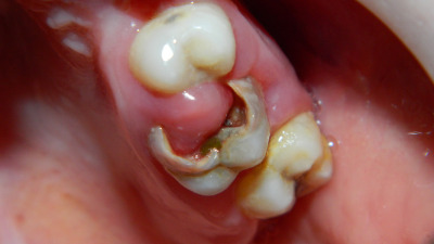 Când extragem un dinte? - plus caz clinic