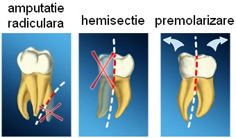 Premolarizarea