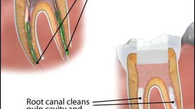 Apexificarea