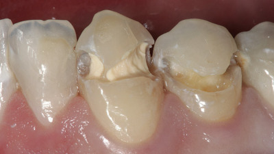 Cimenturile glassionomere cu antibiotice