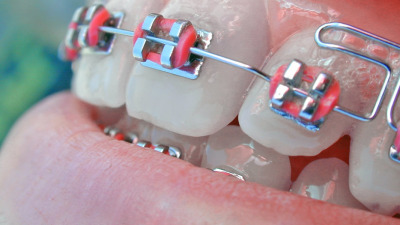 Istoria aparatelor dentare