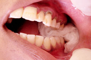 Hemoragia dupa extractia dentara