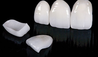 Faţetele dentare fără preparaţie