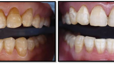 Tratamentul fluorozei dentare