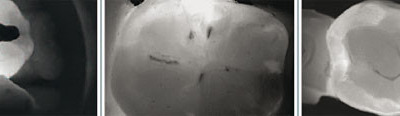 Diagnosticul cariilor fara radiografia dentara