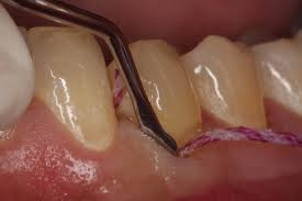Evictiunea gingivala