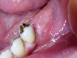 Ameloblastomul