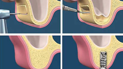 Sinus lifting