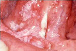 5Leucoplazie neomogena
