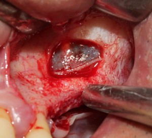 Imagine sinus lift