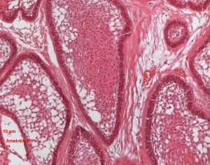 ameloblastomul-histologie