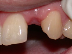 anomalii dentare de numar