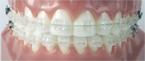 aparat dentar invizibil