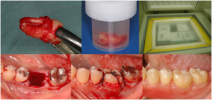 autotransplant dentar