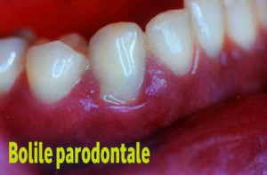 bolile parodontale
