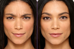 botox fata