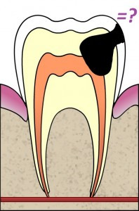 caria-dentara