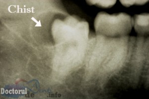 chist molar de minte inclus