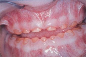 dentinogeneza imperfecta