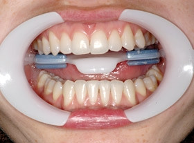 departator oral