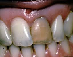 discromia dentara