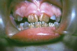 discromie-dentara