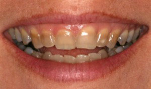 efectul tetreciclinei