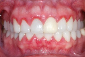 eritem gingival difuz