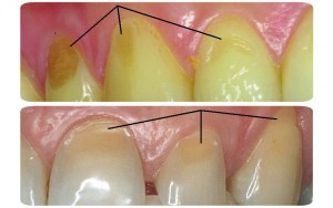 eroziune dentara