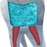 everX Posterior