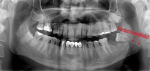 fractura mandibulara