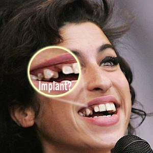 implant dentar