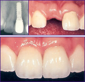 implant unidentar