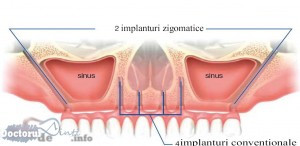 implanturi zigomatice